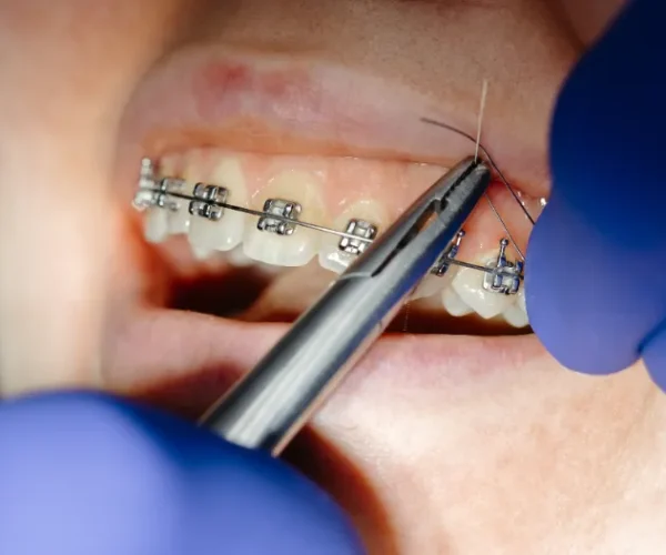 Brace adjustment using orthodontic pliers prepared by an orthodontic assistant.